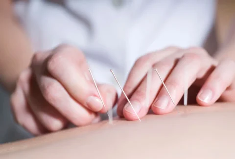 Acupuntura en el tratamiento del estreñimiento funcional crónico severo, centro de salud integrativa ISMET Barcelona