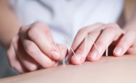 Acupuntura en el tratamiento del estreñimiento funcional crónico severo, centro de salud integrativa ISMET Barcelona