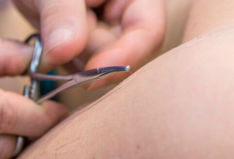 Método Hinaishin, agujas intradérmicas contra el dolor y puntos gatillo acupuntura Trigger, centro de formación ISMET Barcelona