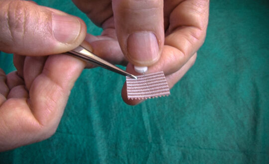 Método Hinaishin, agujas intradérmicas contra el dolor y puntos gatillo acupuntura Trigger