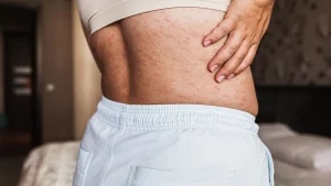 Enfermedades autoinmunes en nutrición y suplementación con fitoterapia, homeopatía, oligoelementos, biosales y terapia floral