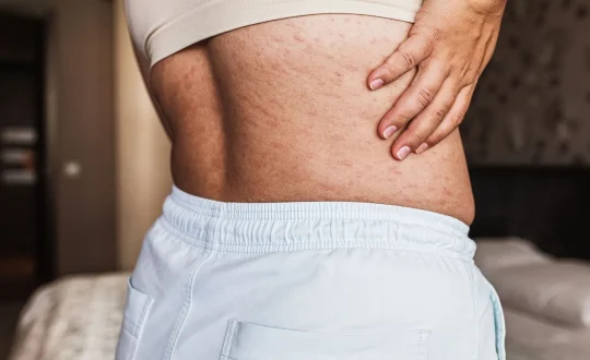 Enfermedades autoinmunes en nutrición y suplementación con fitoterapia, homeopatía, oligoelementos, biosales y terapia floral